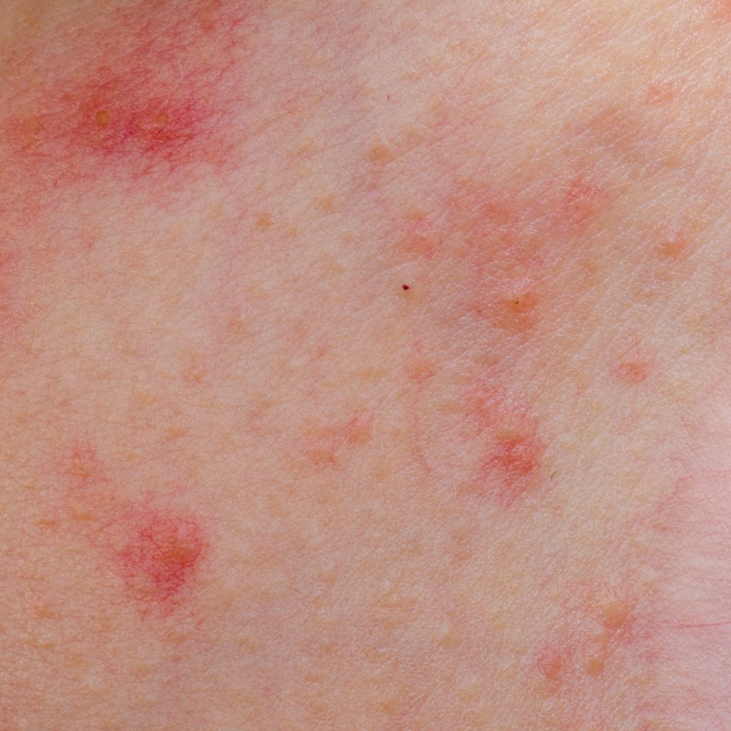Comfrey as related to Cutaneous Drug Reactions - Pictures Comfrey as related to Cutaneous Drug Reactions - Pictures